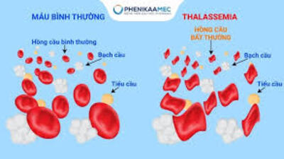 Tuyên truyền Y tế về tan máu bẩm sinh